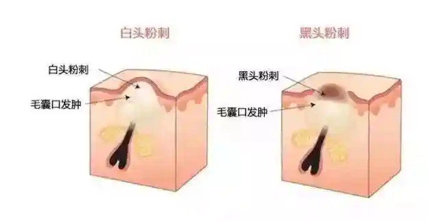 痘痘、闭口粉刺该怎么去除？|皮肤管理干货