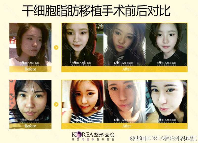 蚌埠首位大学生志愿者成功捐献造血干细胞