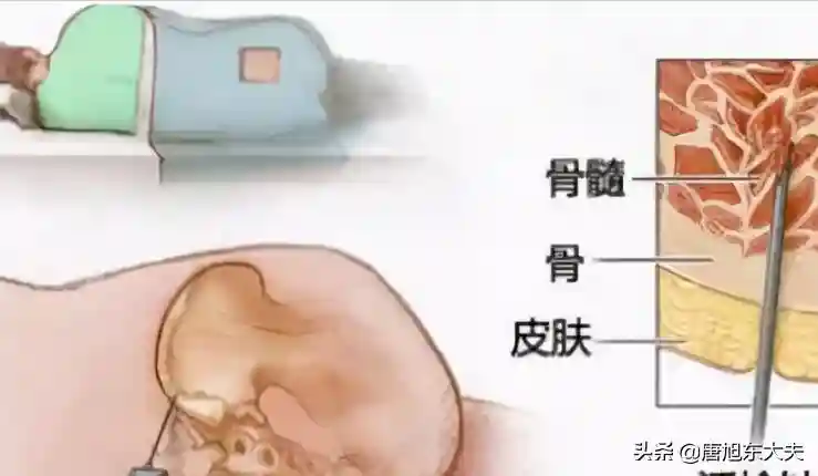 再生障碍性贫血长期输血，能保持正常寿命吗？